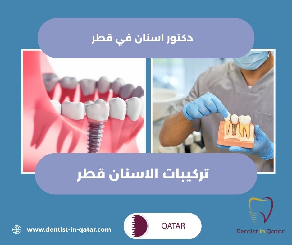 مركز زراعة الاسنان