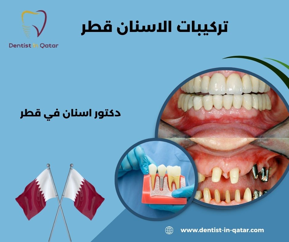 تركيبات الاسنان قطر