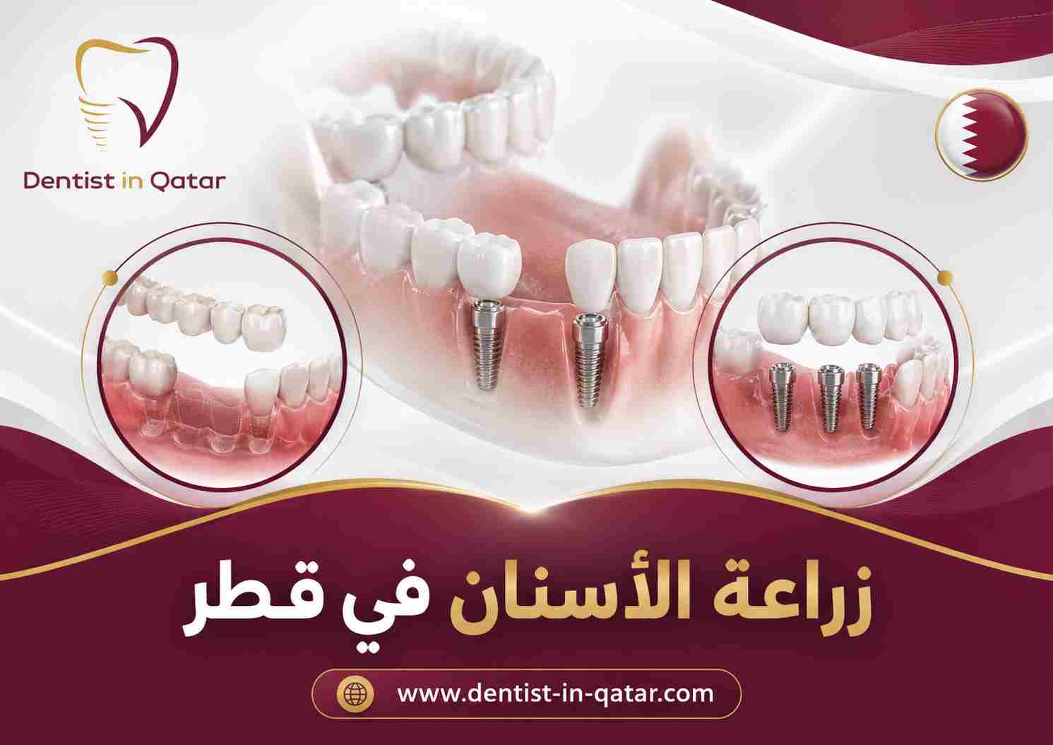 زراعة الأسنان في قطر