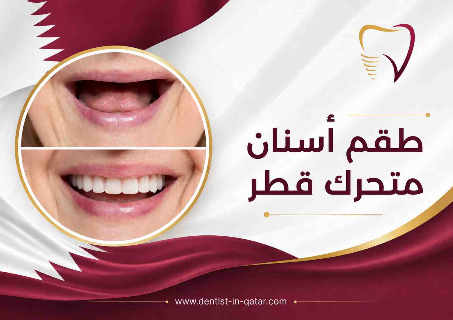 طقم أسنان متحرك قطر