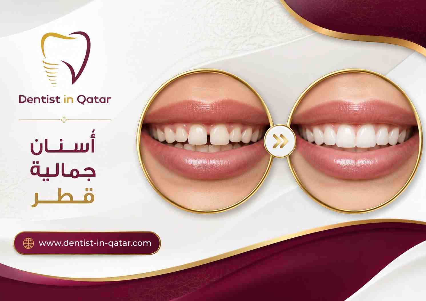 أسنان جمالية قطر أسنان جمالية قطر