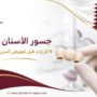 جسور الأسنان قطر