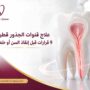 علاج قنوات الجذور قطر