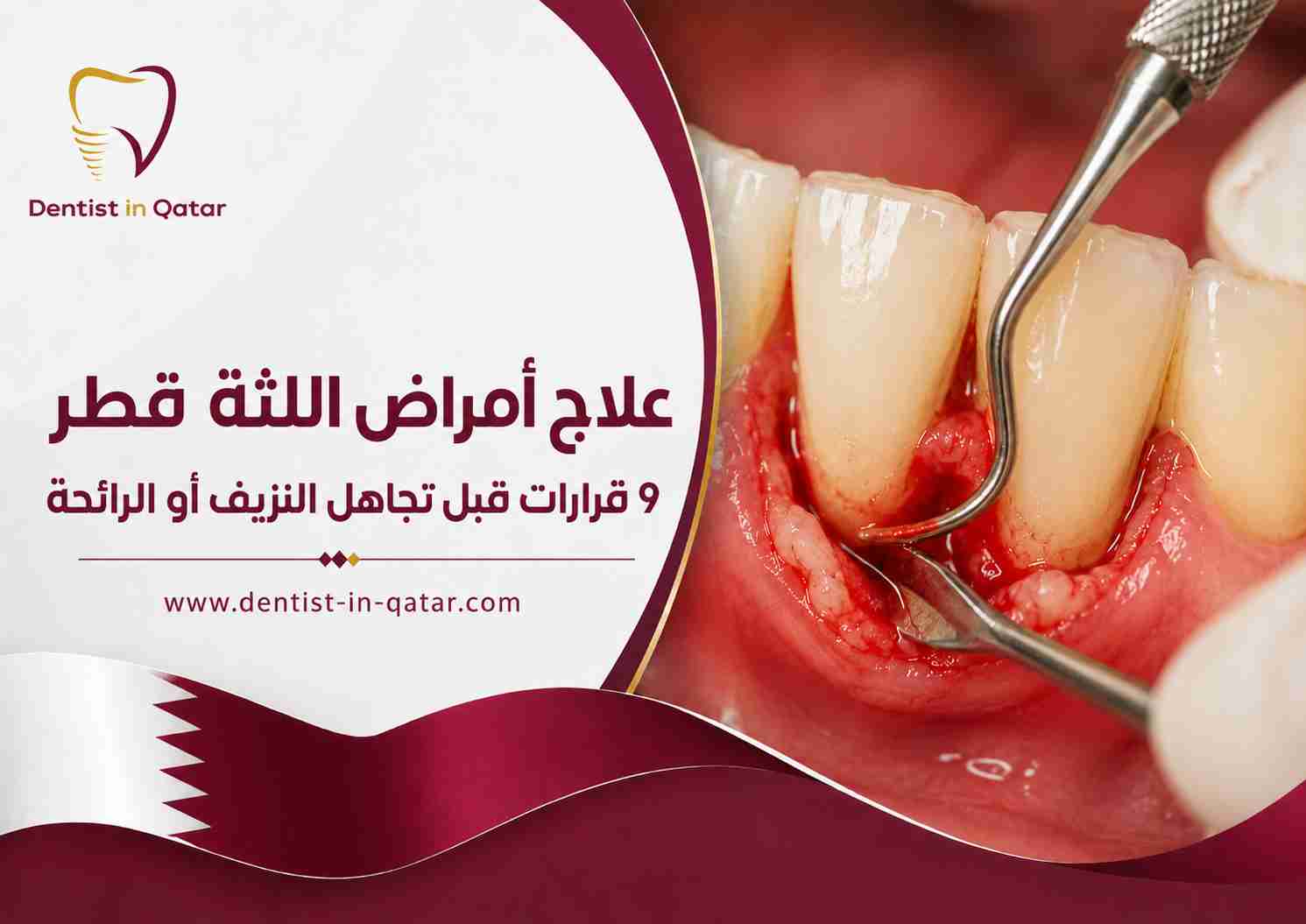 علاج أمراض اللثة قطر