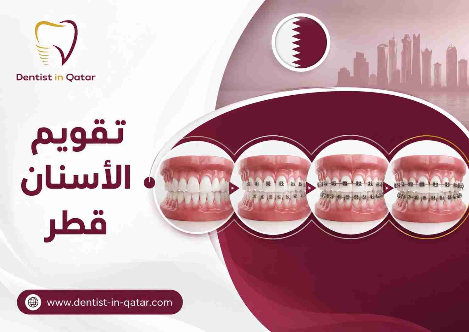 تقويم الأسنان قطر