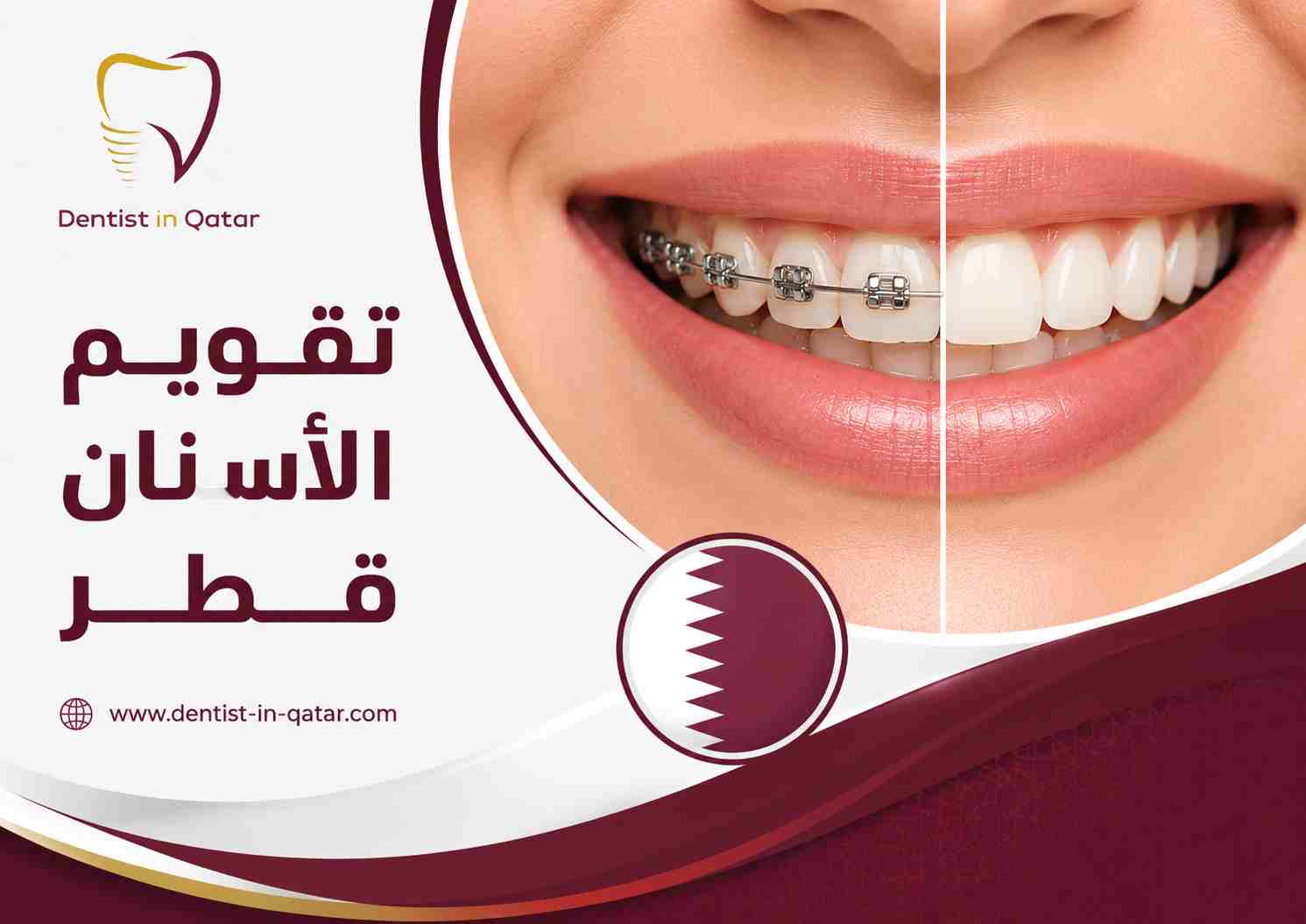 تقويم الأسنان قطر