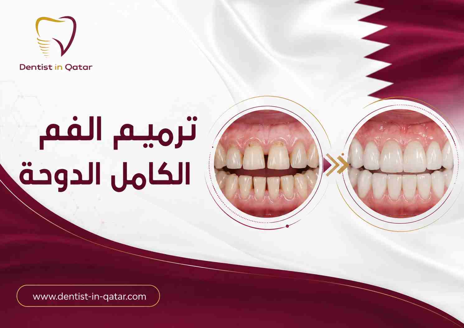 ترميم الفم الكامل الدوحة ترميم الفم الكامل الدوحة