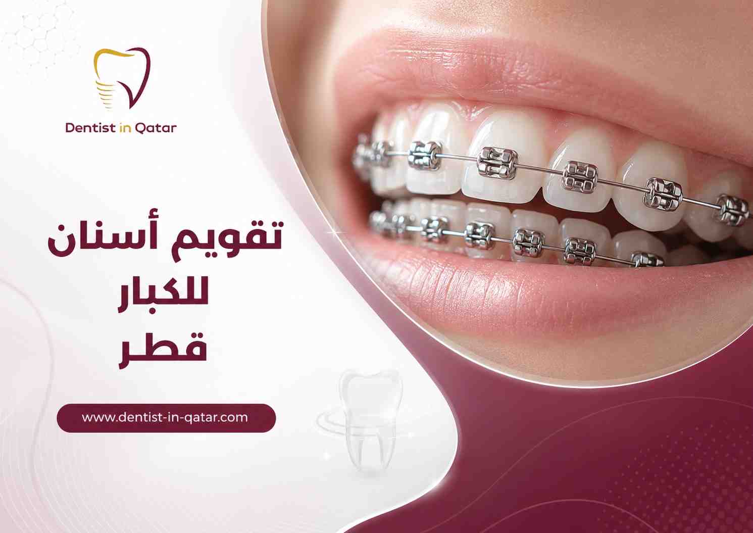 تقويم أسنان للكبار قطر
