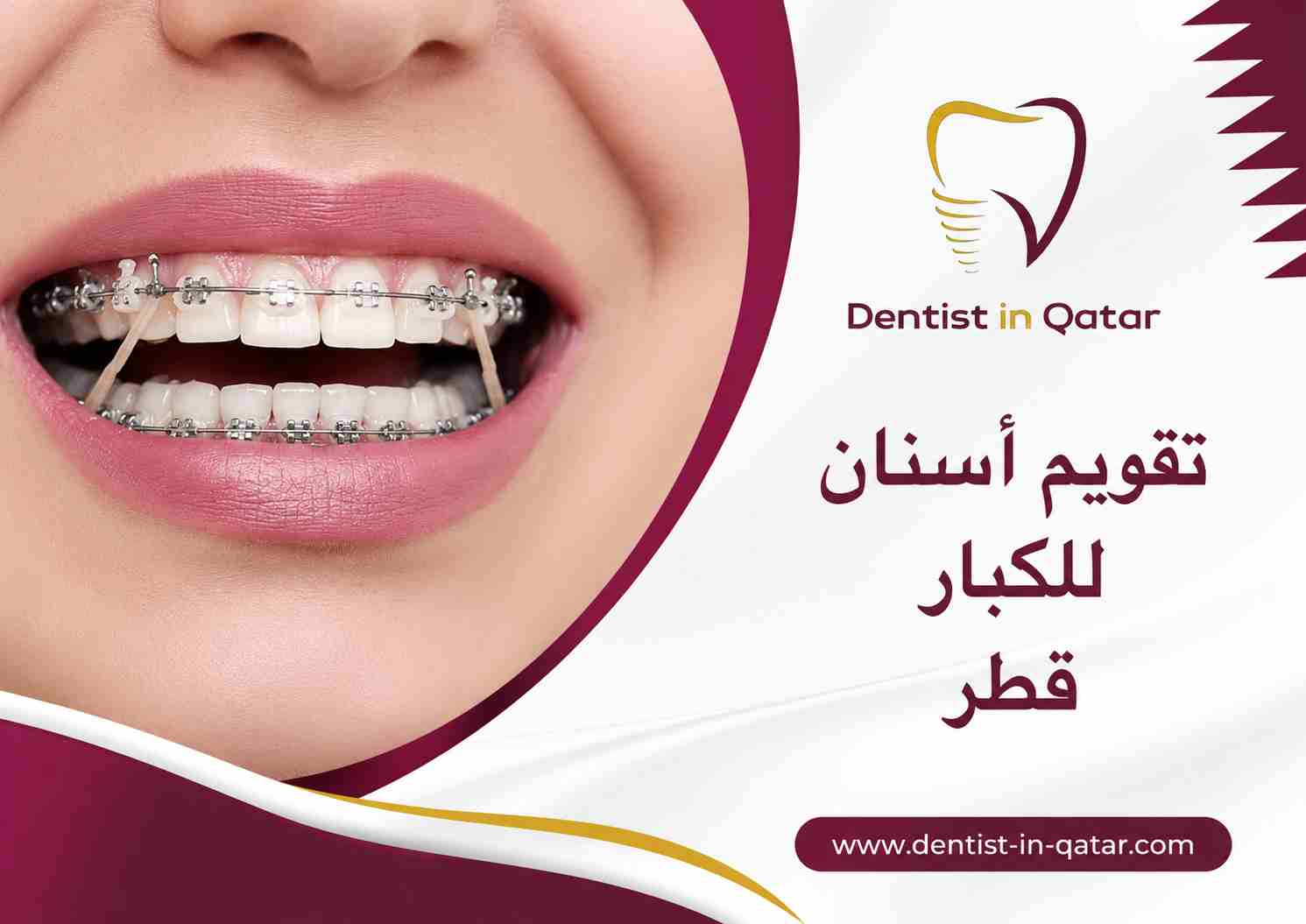 تقويم أسنان للكبار قطر