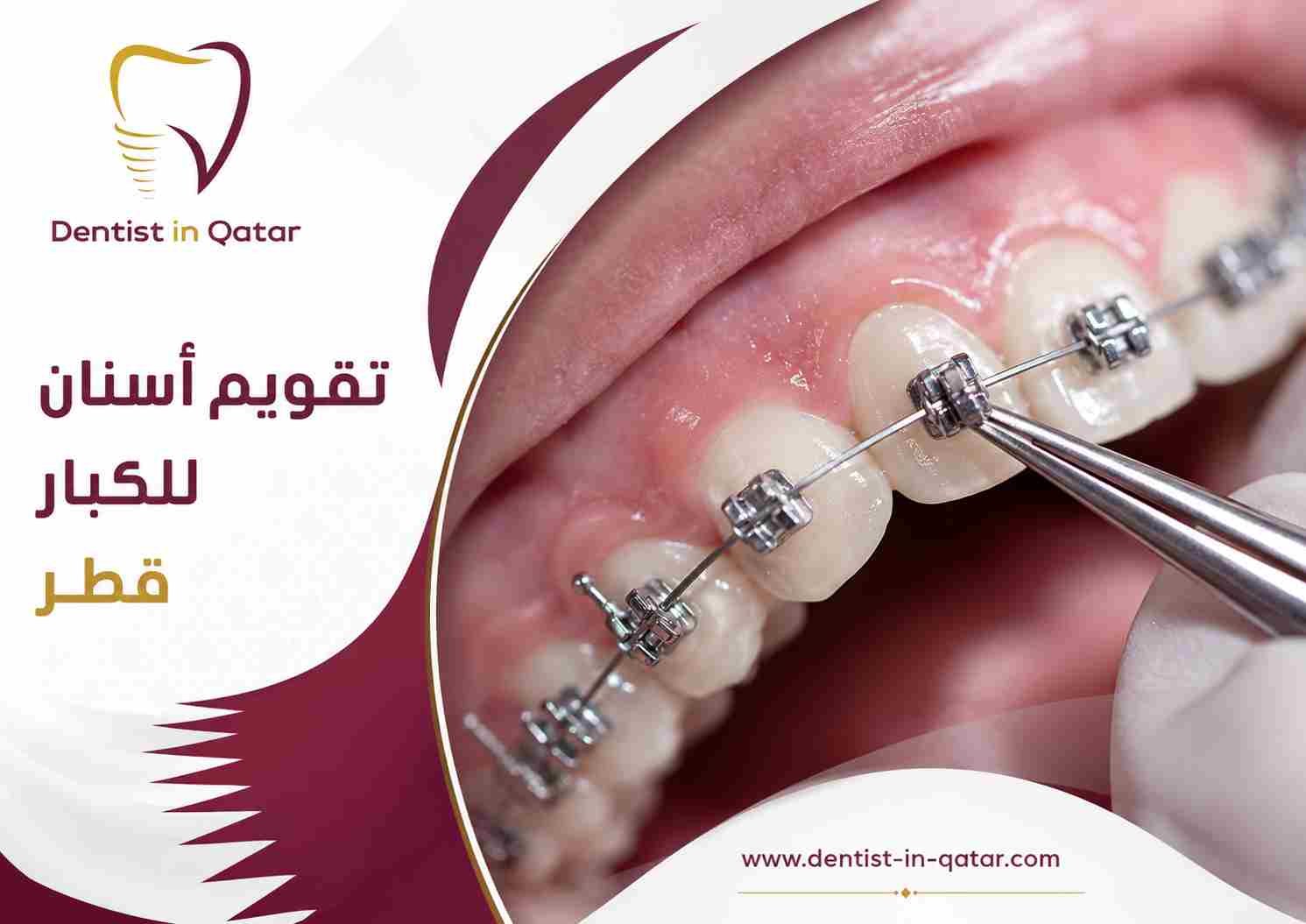 تقويم أسنان للكبار قطر
