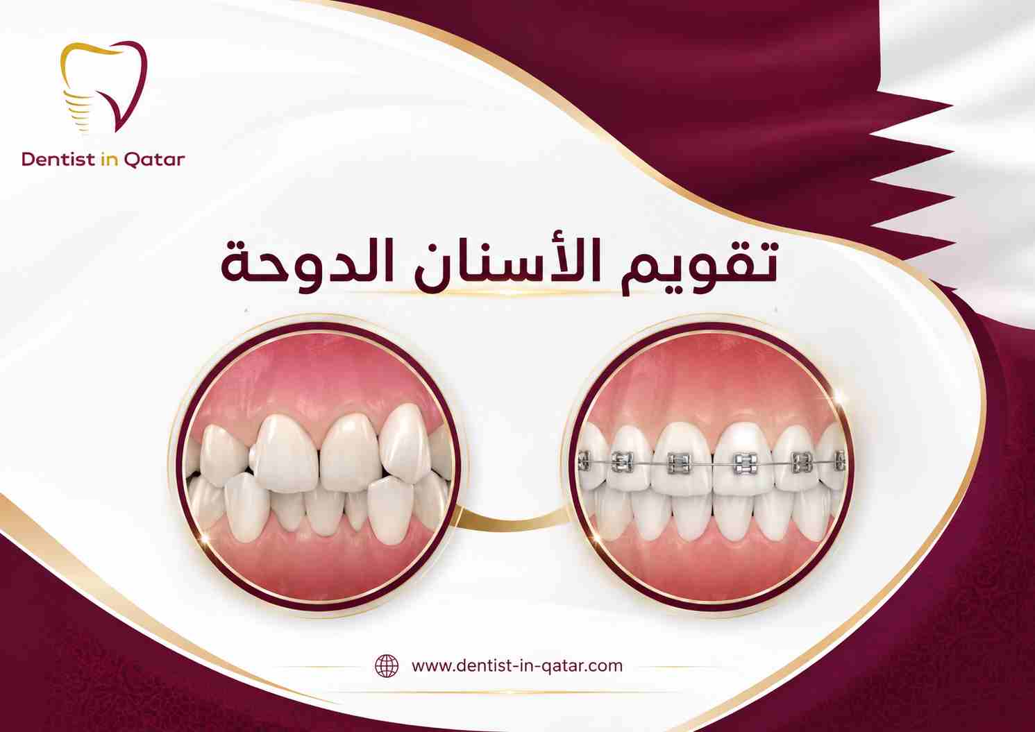 تقويم الأسنان الدوحة تقويم الأسنان الدوحة