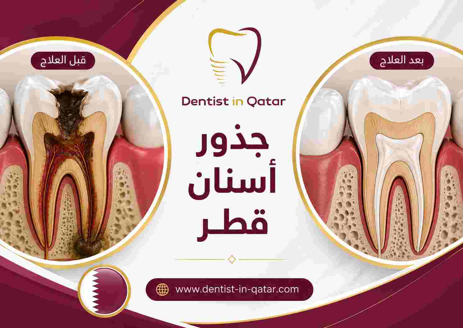 جذور أسنان قطر
