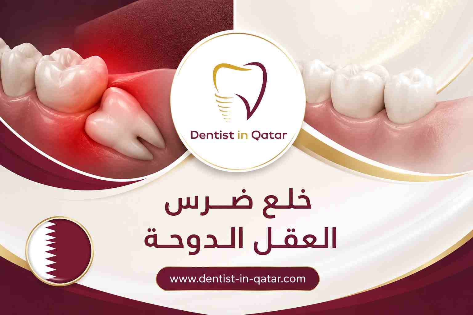 خلع ضرس العقل الدوحة