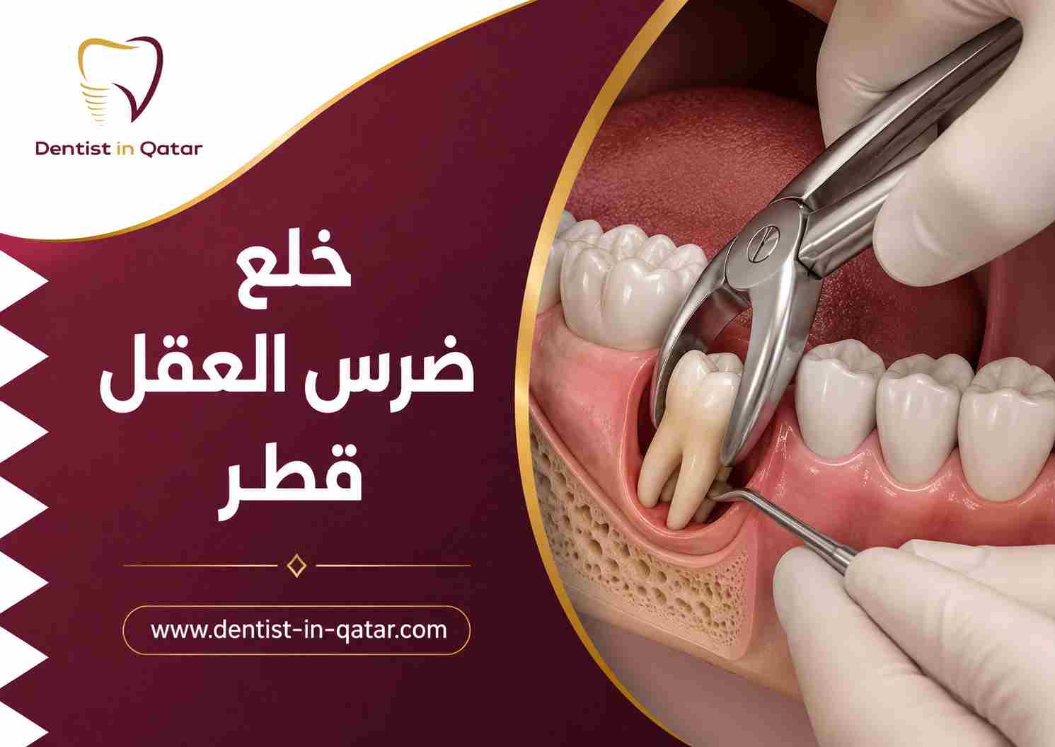 خلع ضرس العقل قطر خلع ضرس العقل قطر