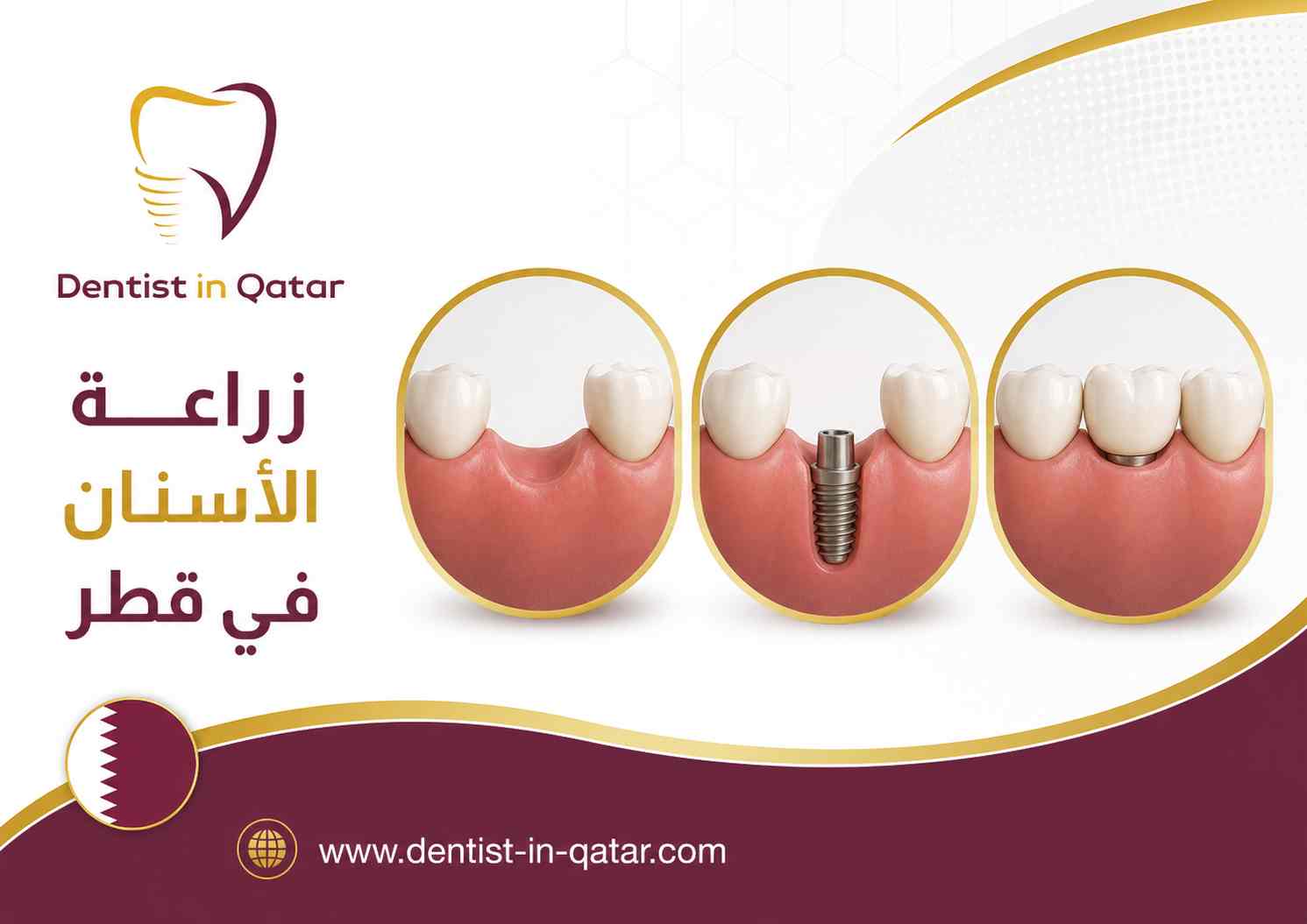زراعة الأسنان في قطر زراعة الأسنان في قطر