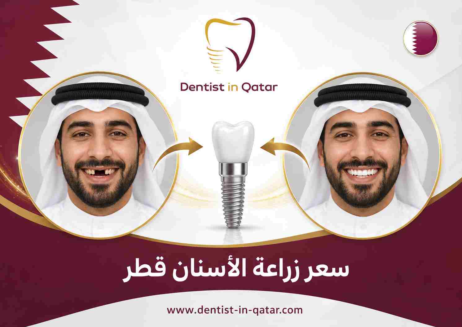 سعر زراعة الأسنان قطر سعر زراعة الأسنان قطر
