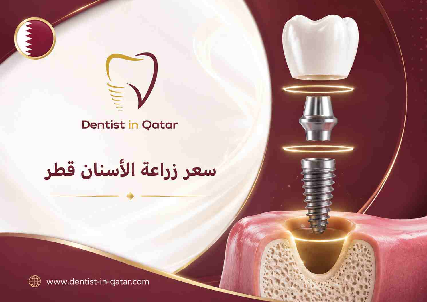 سعر زراعة الأسنان قطر سعر زراعة الأسنان قطر