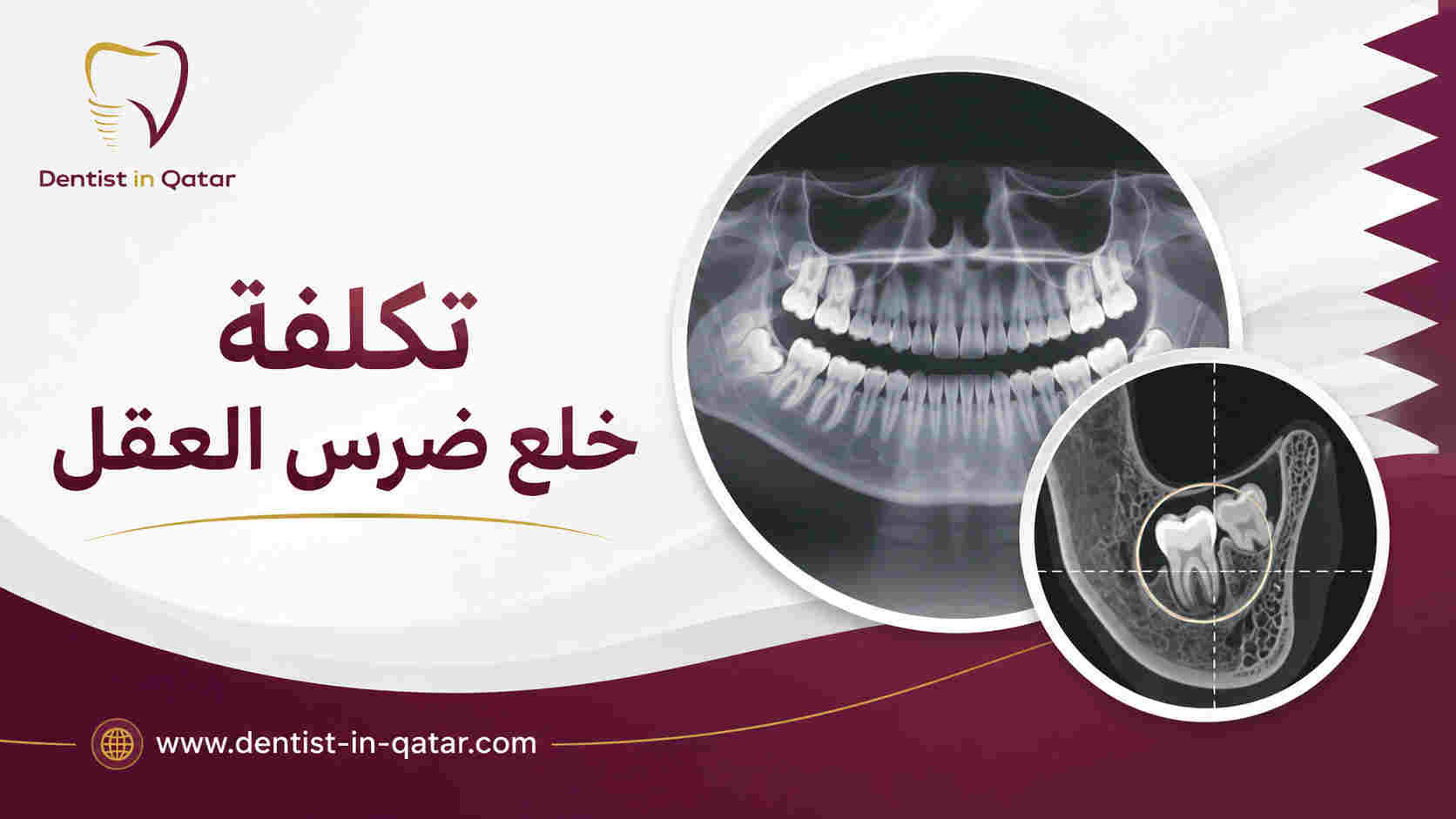 تكلفة خلع ضرس العقل 