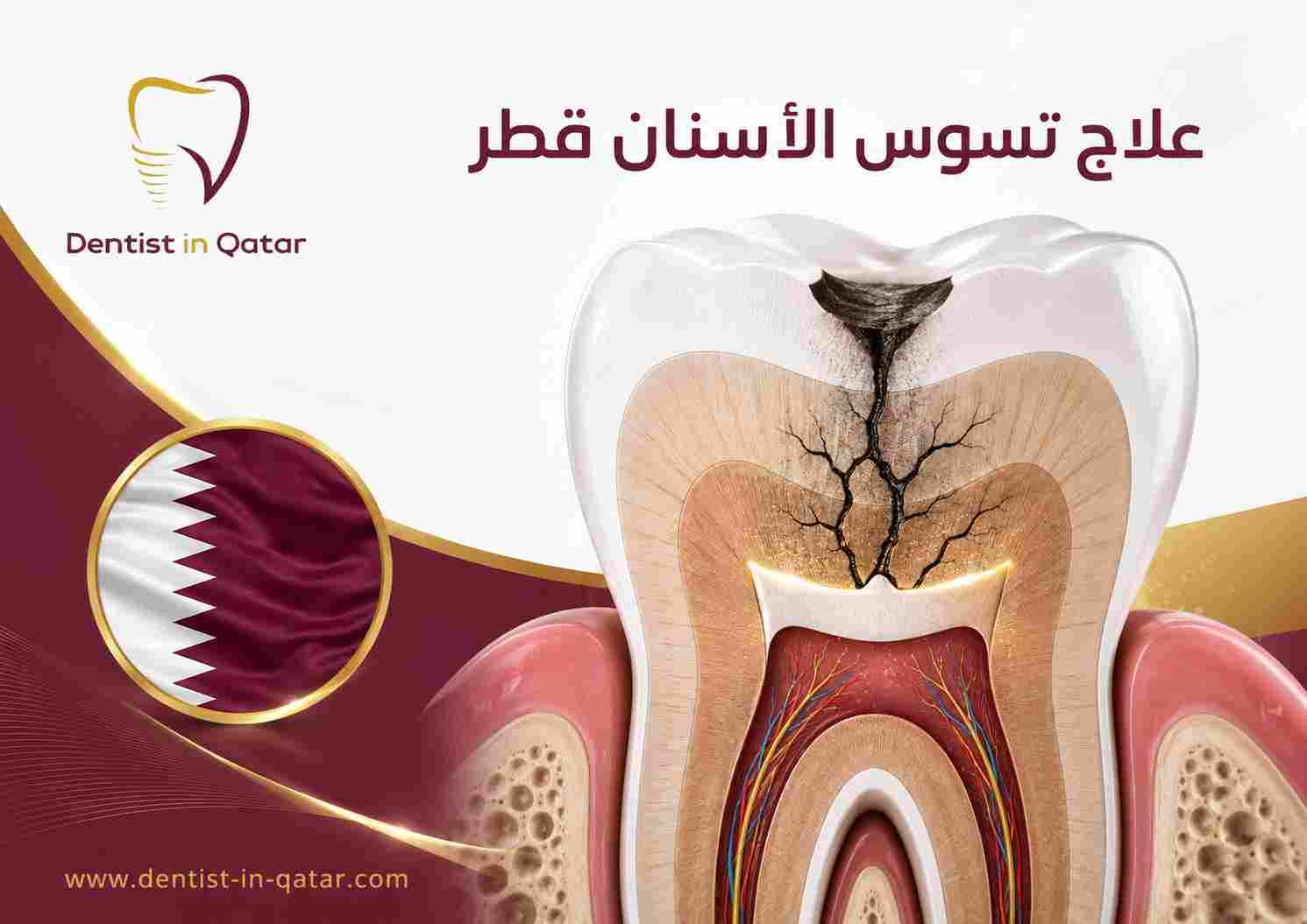 علاج تسوس الأسنان قطر