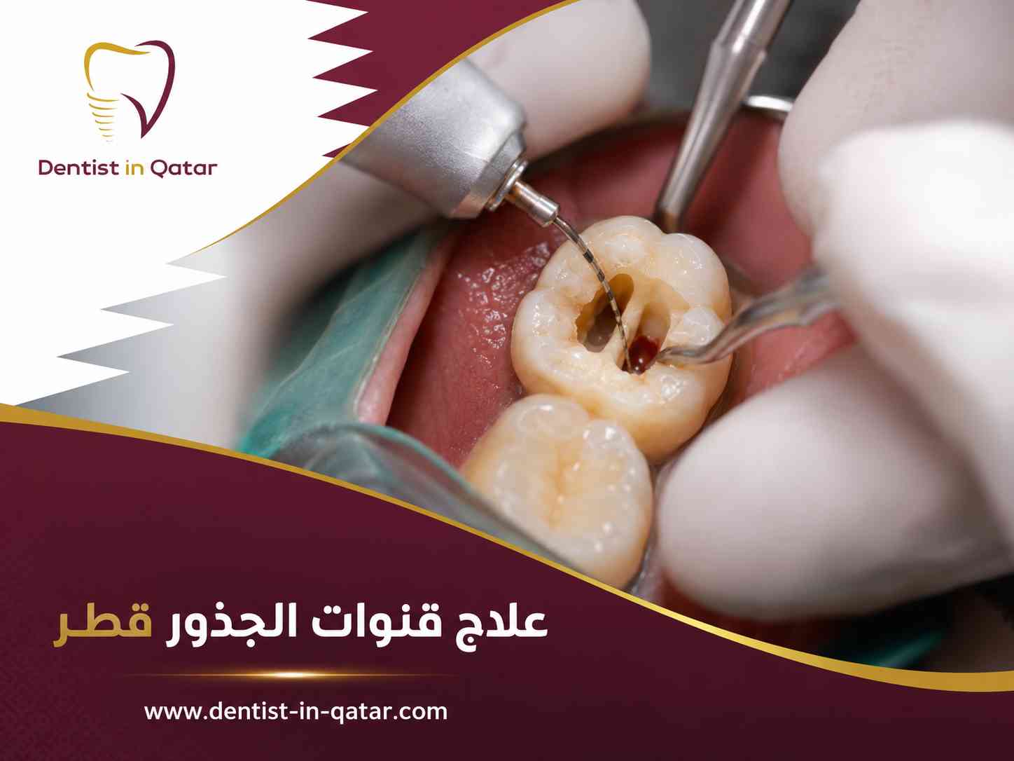 علاج قنوات الجذور قطر علاج قنوات الجذور قطر
