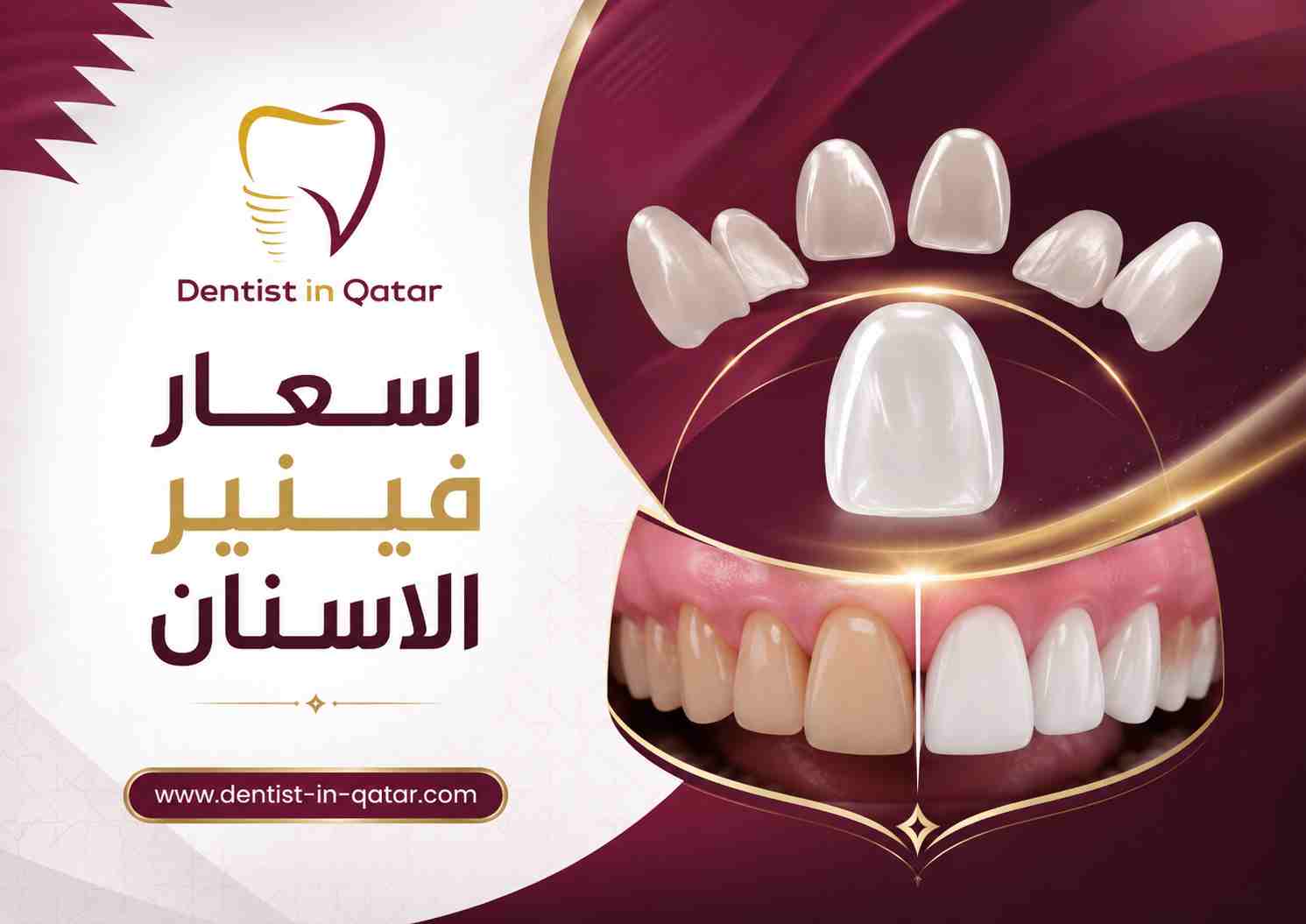 اسعار فينير الاسنان اسعار فينير الاسنان