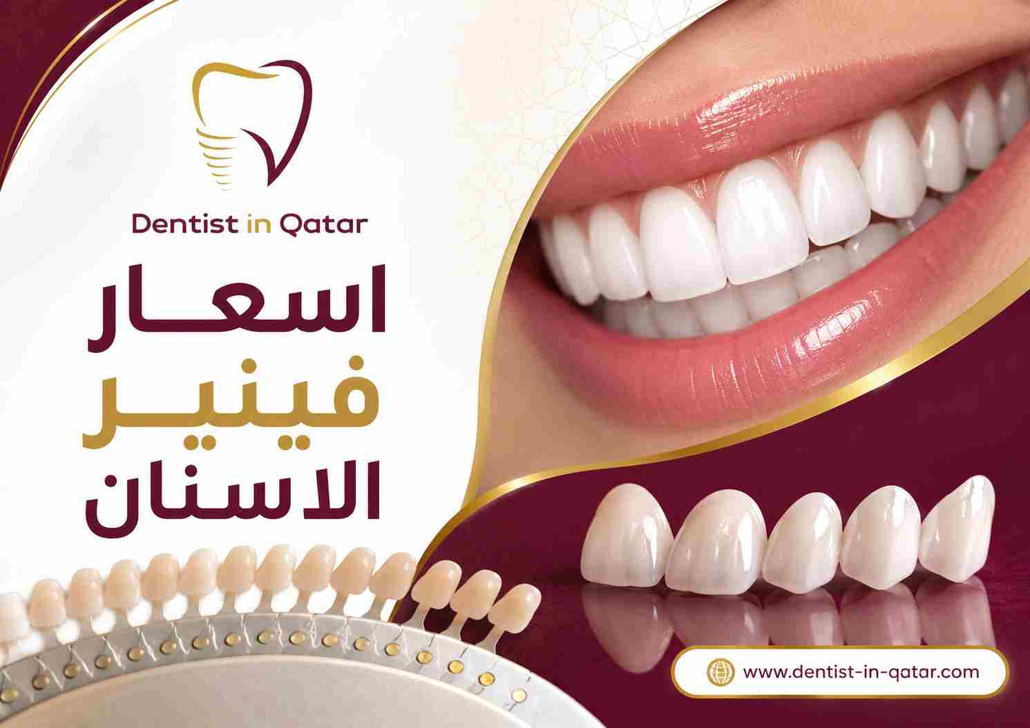 اسعار فينير الاسنان اسعار فينير الاسنان
