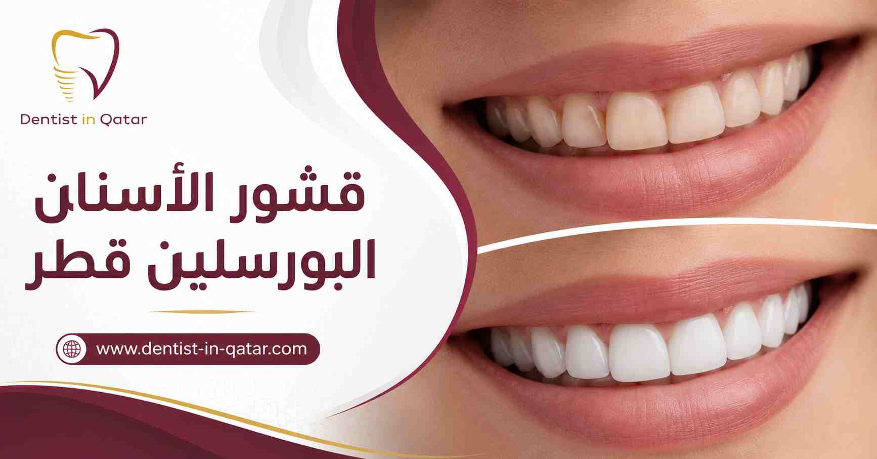 قشور الأسنان البورسلين قطر قشور الأسنان البورسلين قطر