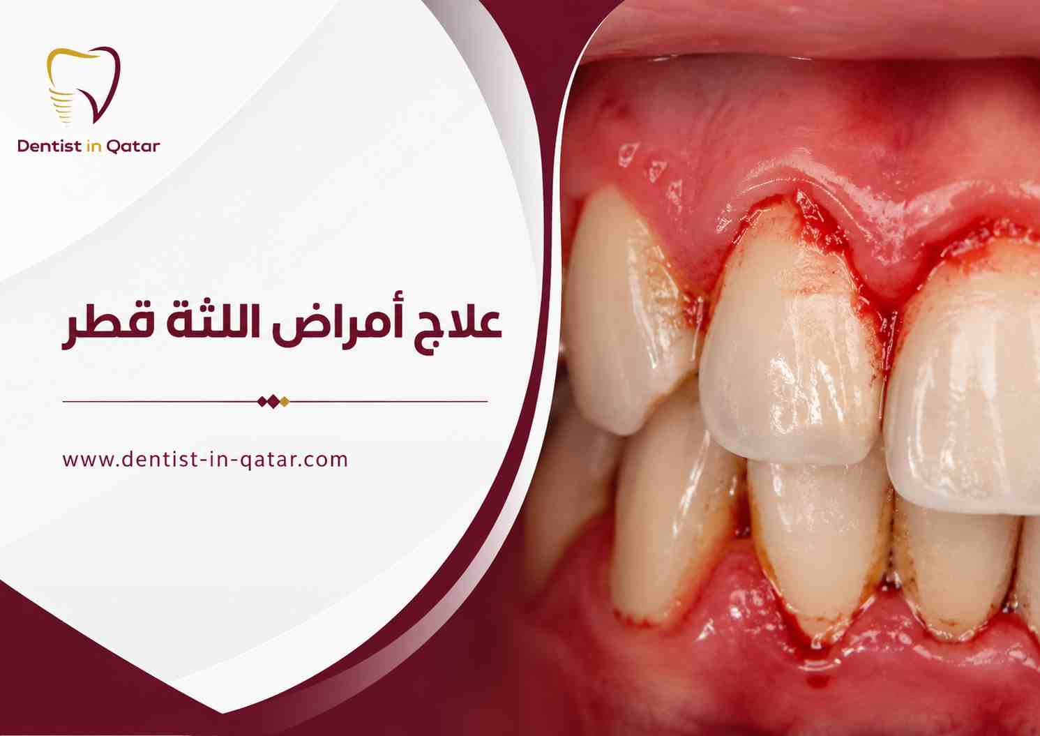 علاج أمراض اللثة قطر علاج أمراض اللثة قطر