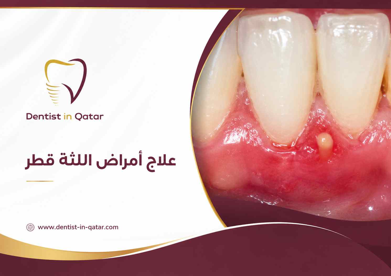 علاج أمراض اللثة قطر علاج أمراض اللثة قطر