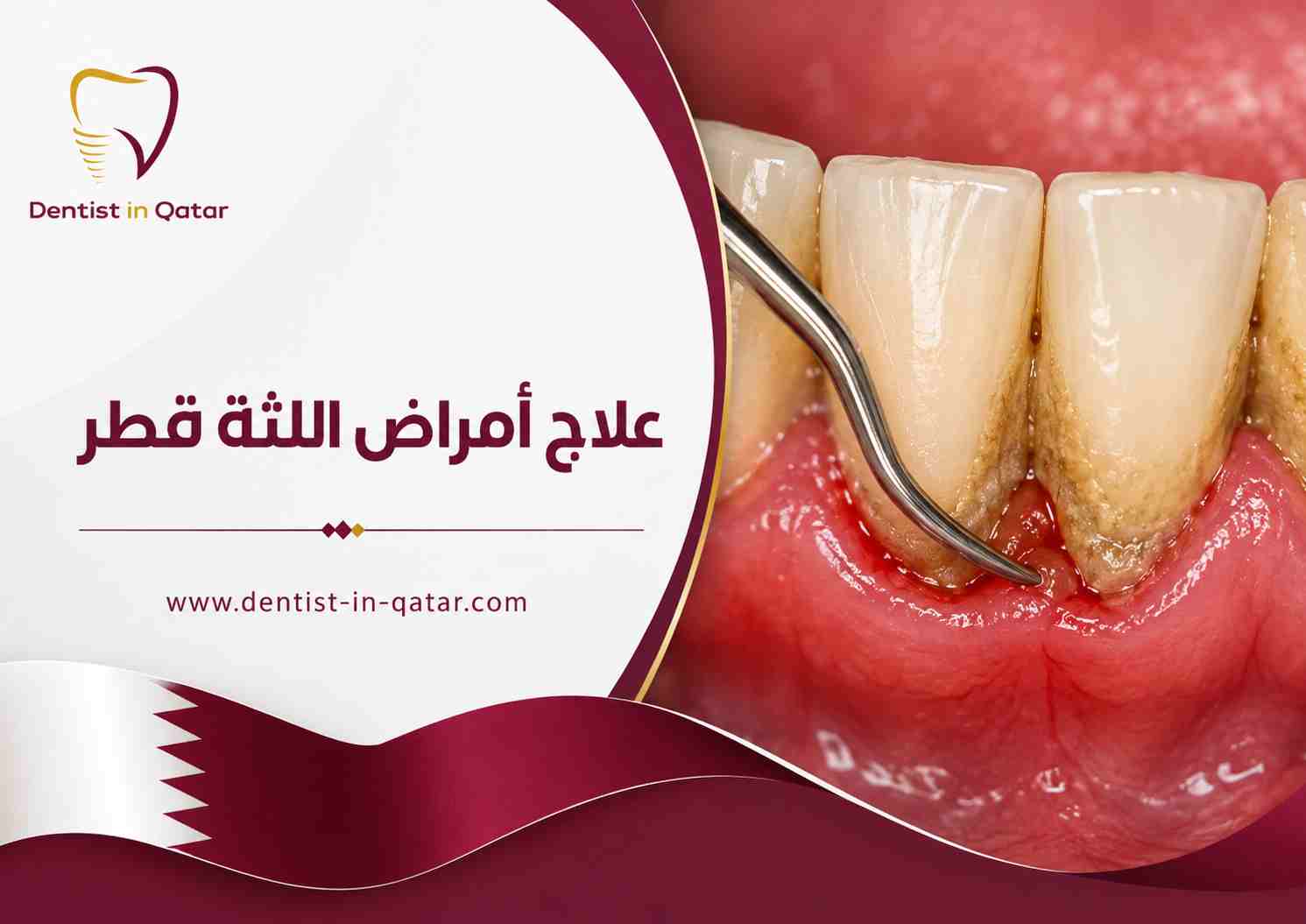 علاج أمراض اللثة قطر علاج أمراض اللثة قطر