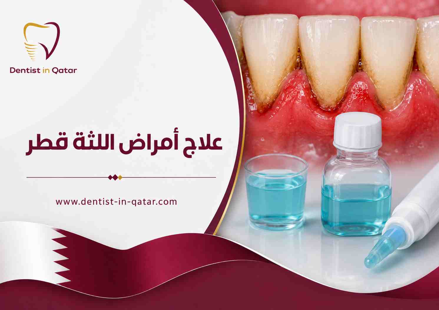 علاج أمراض اللثة قطر علاج أمراض اللثة قطر