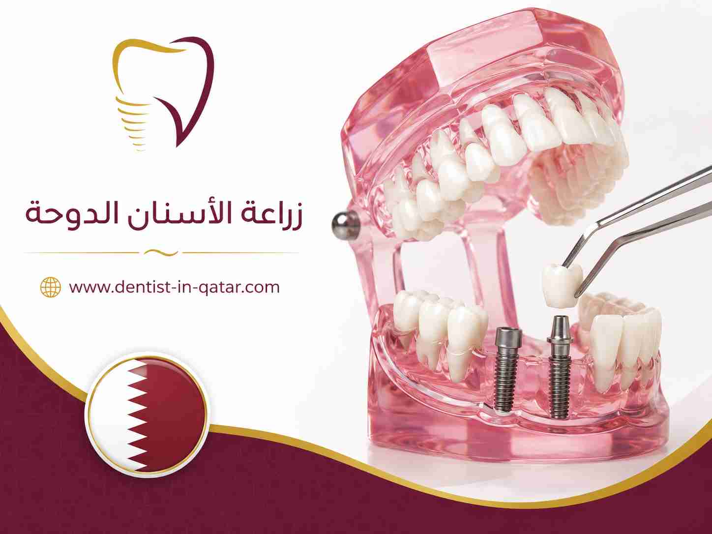 زراعة الأسنان الدوحة