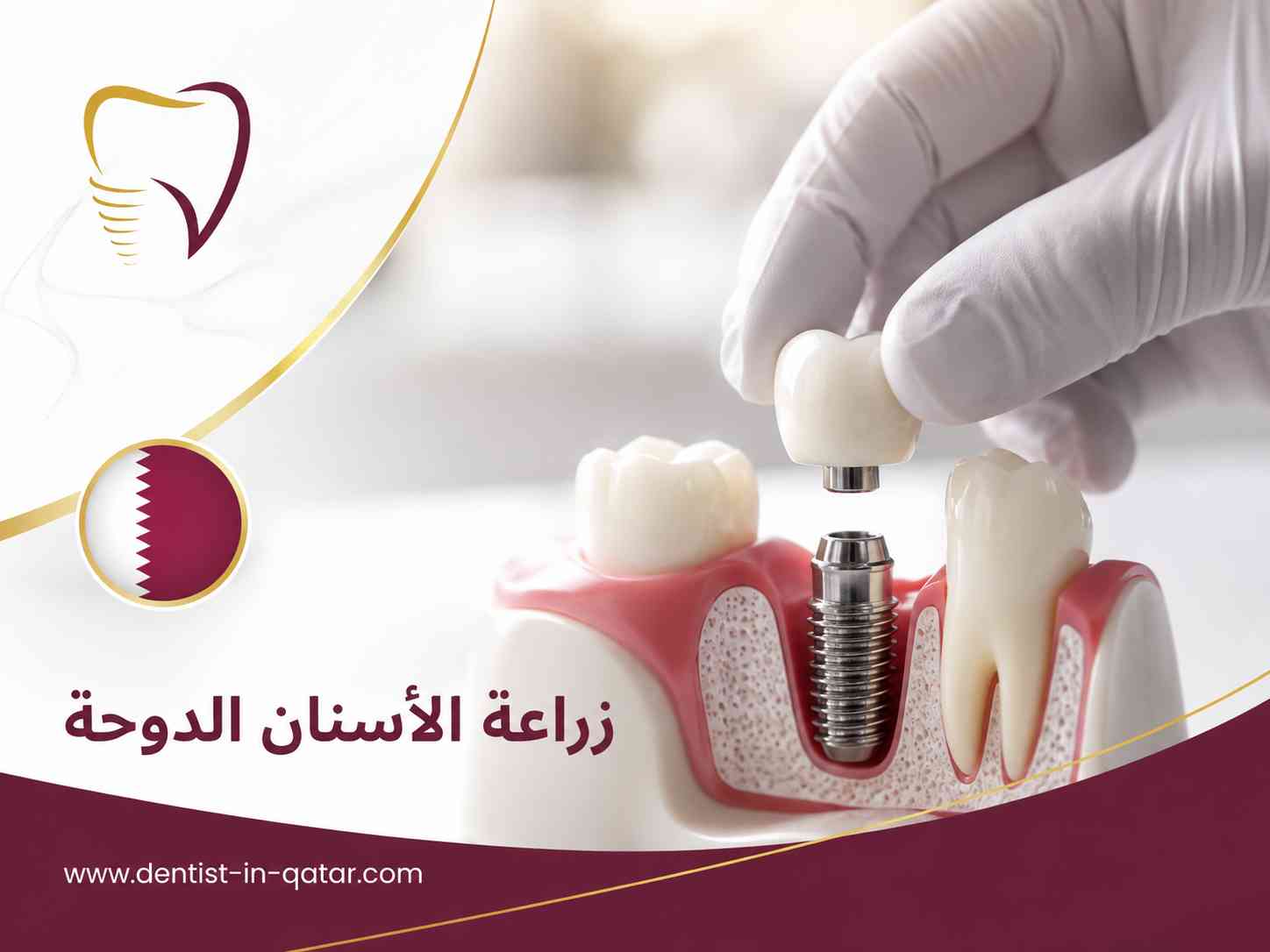 زراعة الأسنان الدوحة